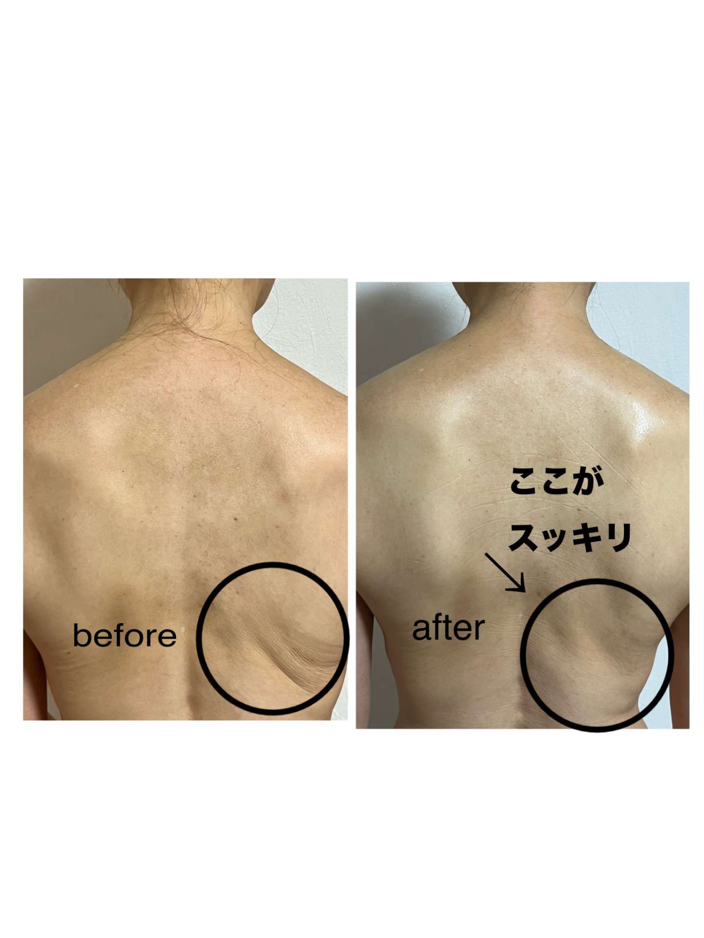 憧れの美背中へ!光美容機器「メティス」で叶える、引き締まった背中ライン