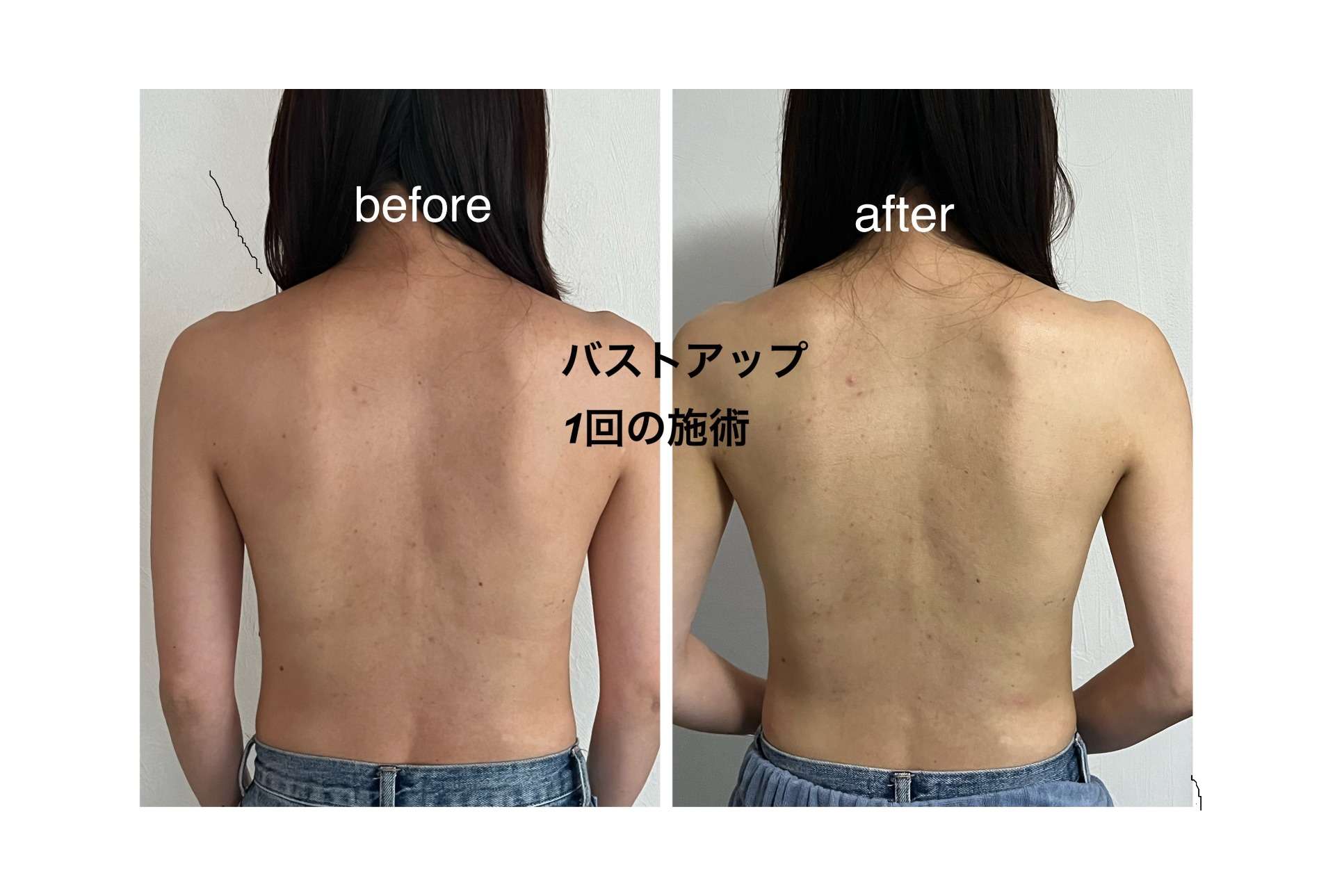 施術1回でここまで変化!背中がキュッと締まり、肌もなめらかに!